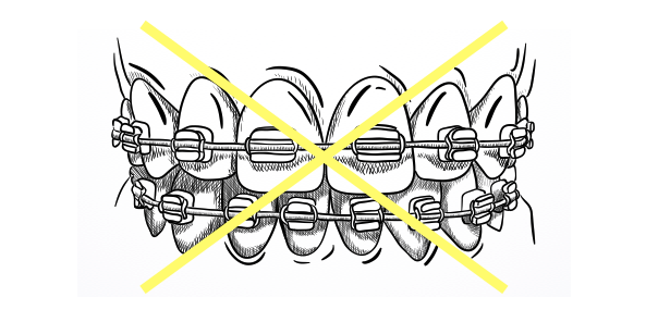 インビザライン・ワイヤーつけたくない